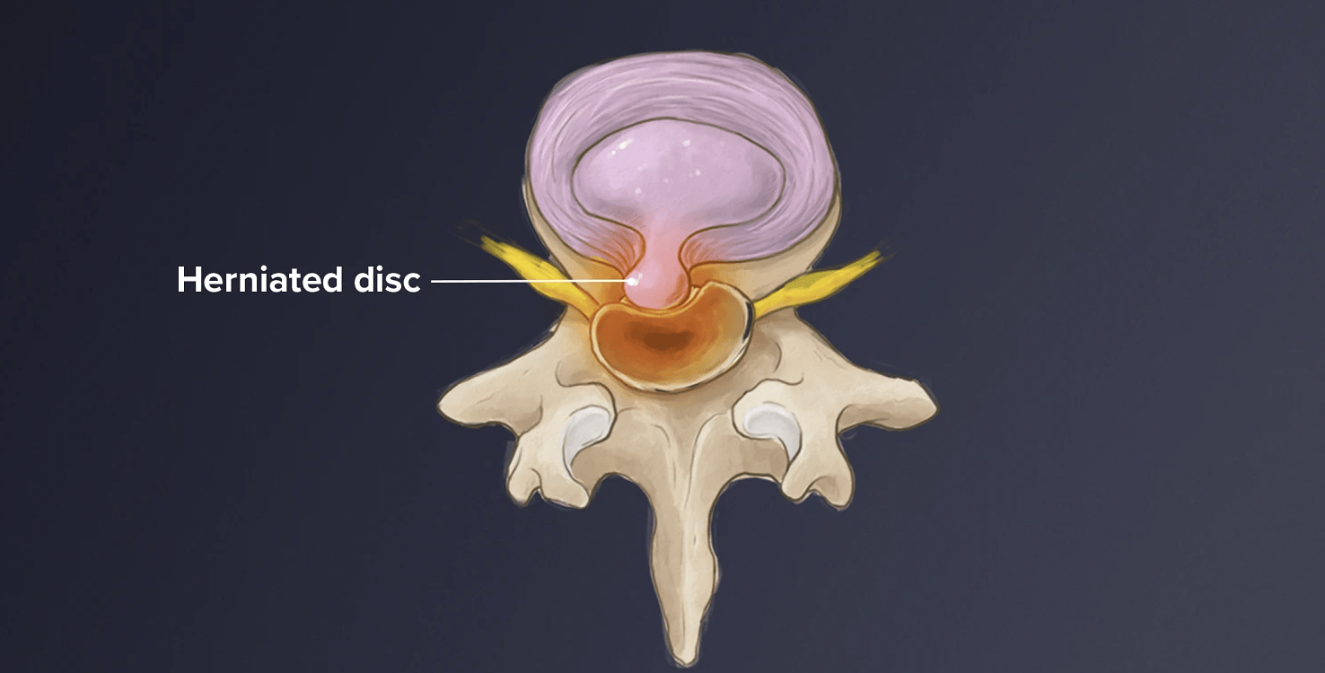 عمل دیسک گردن چیست + ویزیت رایگان عمل دیسک گردن چیست + ویزیت رایگان